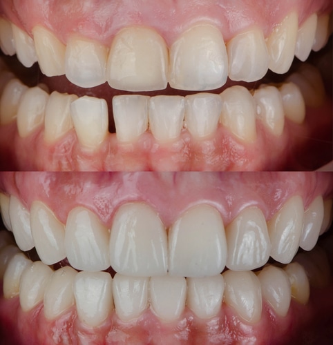 smile makeover
