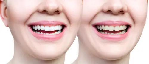 Chipped Tooth Repair - Premier Smile Dentistry Is There To Help
